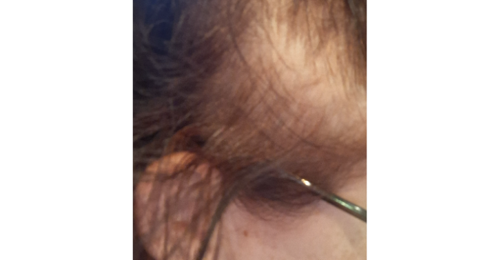 Haarverlies therapie